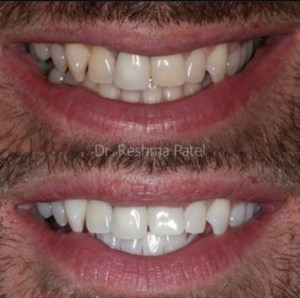 Teeth Whitening before and after