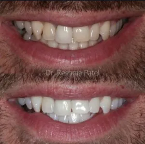 Teeth Whitening before and after