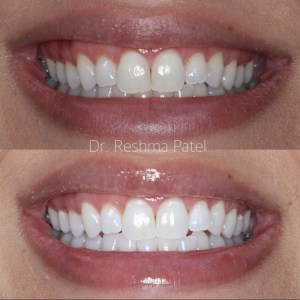 before and after zoom whitening