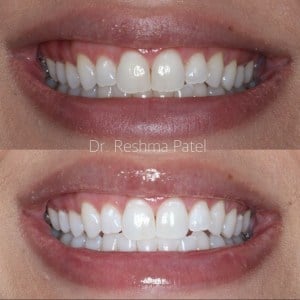before and after zoom whitening