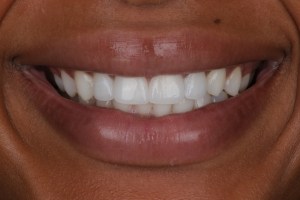 porcelain veneers in Orlando