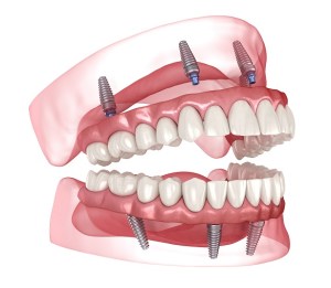 Model of all-on-4 dental implants